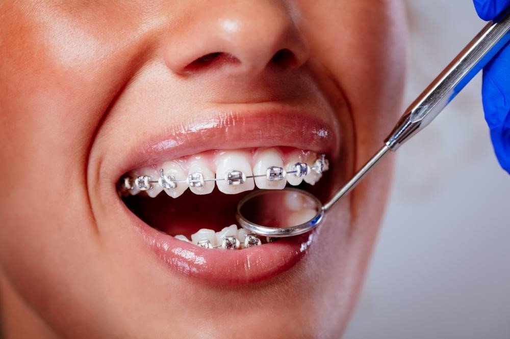 How Much Are Braces? The Ultimate Guide to Costs and Options