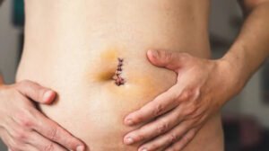 How Long Does It Take for Stitches to Dissolve? Complete Guide